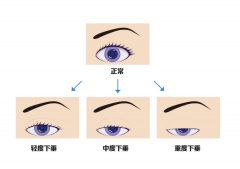 眼皮耷拉抬不起，除了没睡醒，还有可能是这种情况