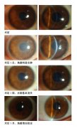 15岁少年频换眼镜视力仍连续下降  竟是圆