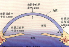 先天性大角膜并发白内障，陈伟主任妙手