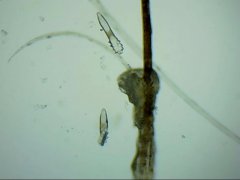 高中生看病搞乌龙,眼睛痒不因粉尘因螨