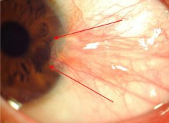 厦门眼科中心告诉你翼状胬肉手术该什么