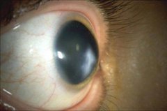 幸运！高中生靠角膜交联保住视力