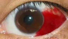 愚人节，我们聊聊那些会骗人的眼病