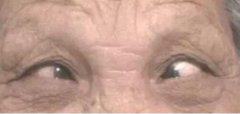 拯救“消失”的黑眼球--75岁老奶奶超高度