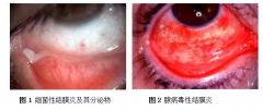 科普 | 正确分析疫情下的结膜炎！