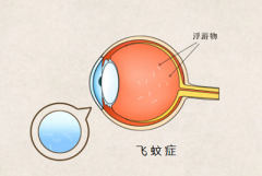 眼前老有蚊子飞？当心是这种眼病！