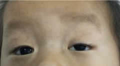 2岁幼童重度上睑下垂怎么办？低龄儿治疗