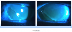 电光性眼炎工人自制盐水泡眼睛，双眼角
