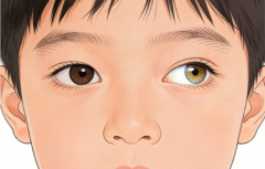 查出斜视应该怎么治疗？