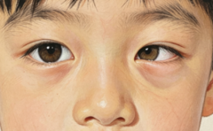斜视的危害大不大？