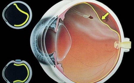 视网膜脱落
