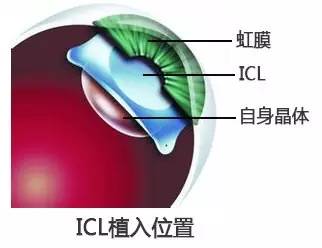 近视眼icl手术过程