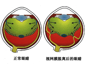 视网膜脱落