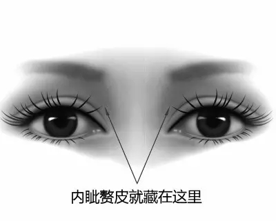 内眦赘皮是指通过内眦部垂直向下的皮肤皱褶,自上而下呈顺向性