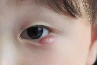 儿童霰粒肿一定要手术吗
