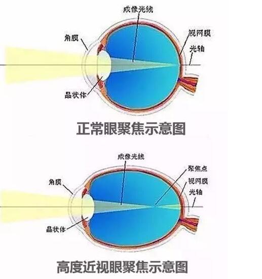 近视600度以上的朋友可得小心了!这些事儿应当别做