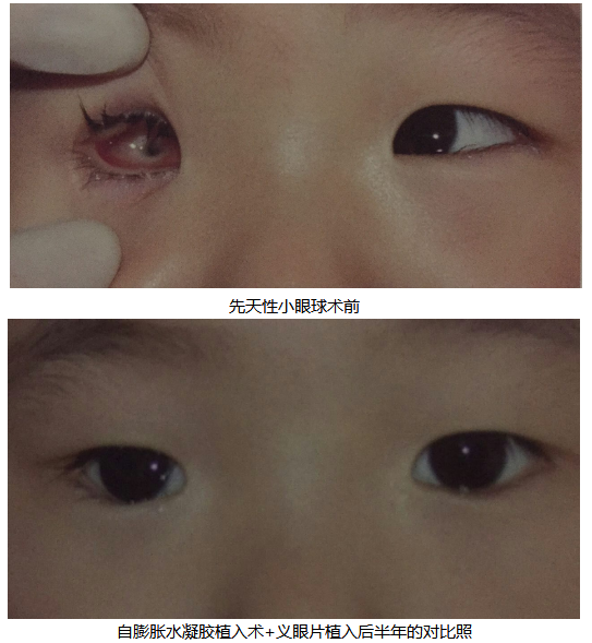 眼球基弧小是为什么,眼球基弧小什么原因