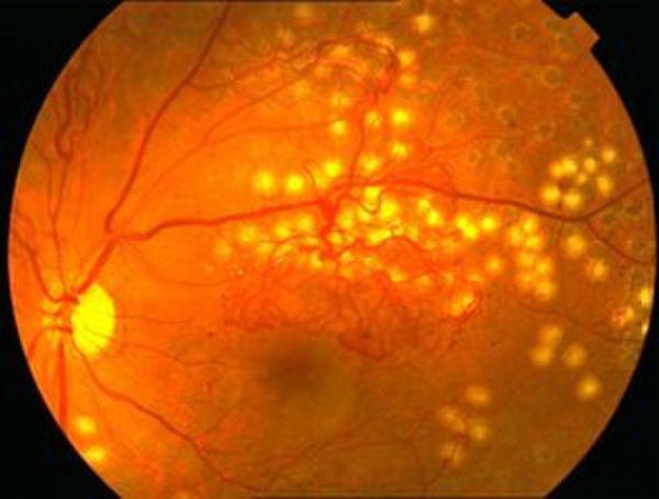 造成眼底出血的因素