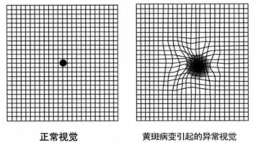 黄斑变性