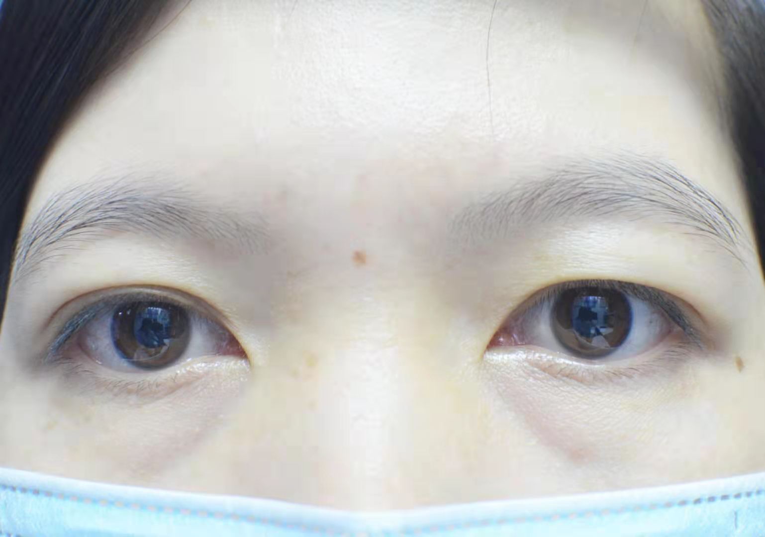「五合一隐痕眼袋手术」–眼袋泪沟一次解决，同步修饰黑眼圈 | 佳思优整形医美诊所