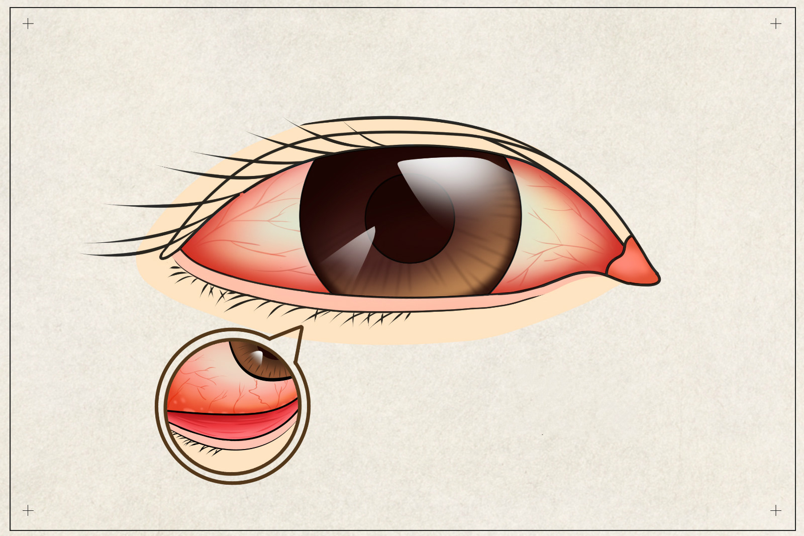 What Is eyelid dermatitis? Symptoms, diagnosis & treatment - www ...