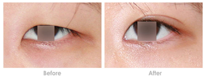 上睑下垂手术案例前后对比