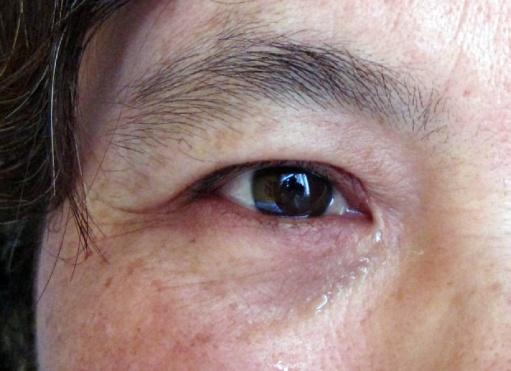 泪道阻塞的症状