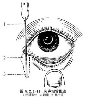 泪道探通手术
