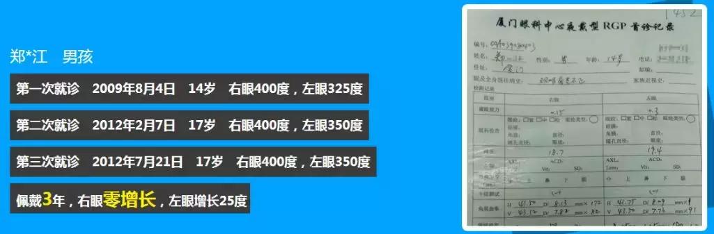 角膜塑形镜