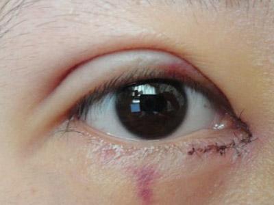 为什么医生不建议开外眼角