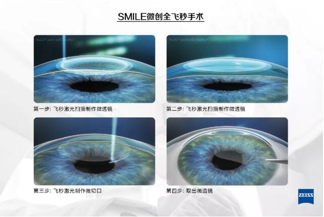 全飞秒激光近视眼手术