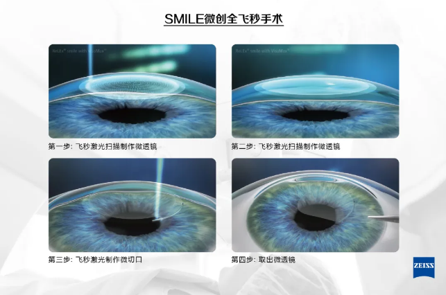 全飞秒激光SMILE