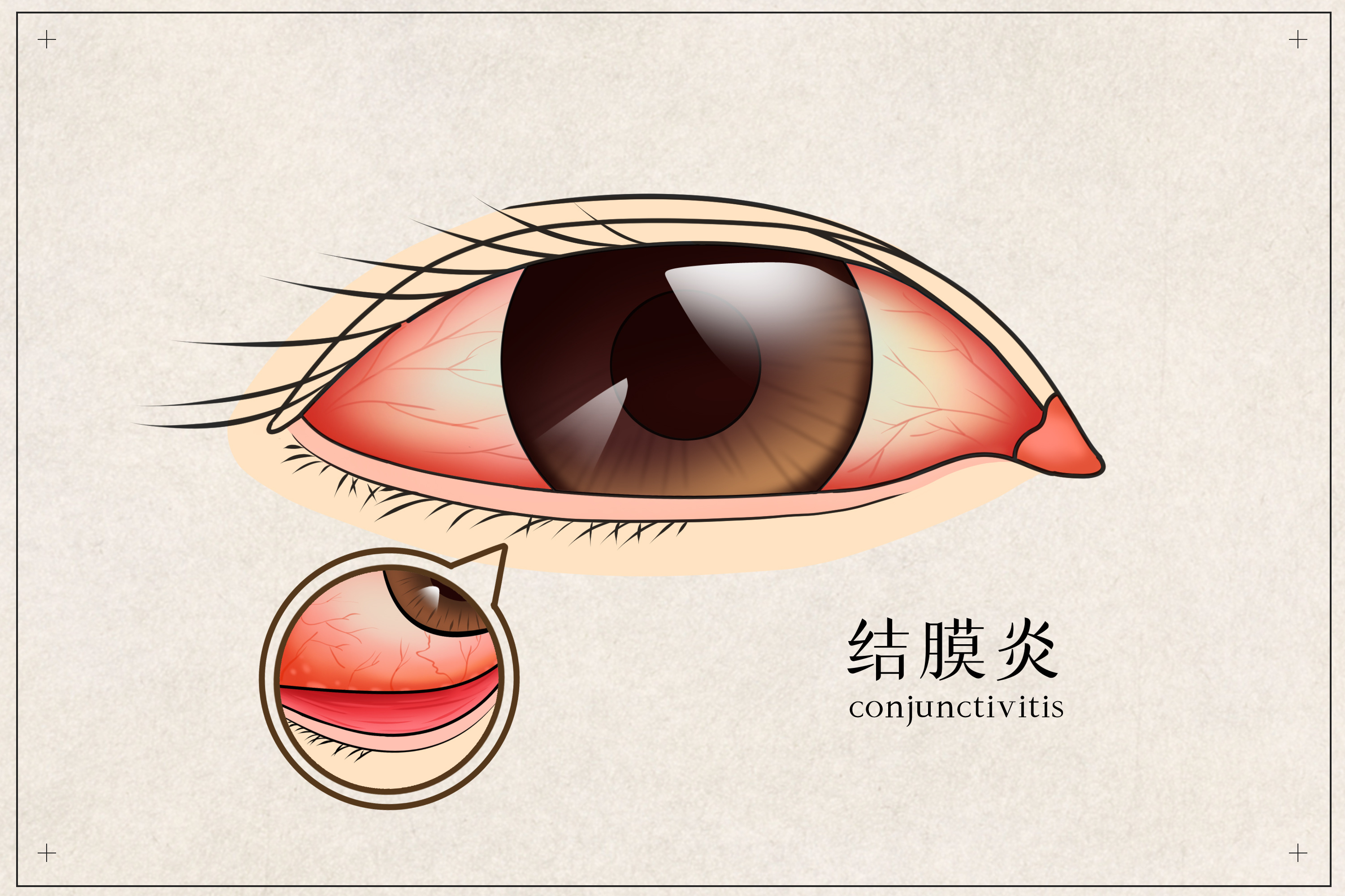 眼结膜囊肿手术前后对照 - 知乎