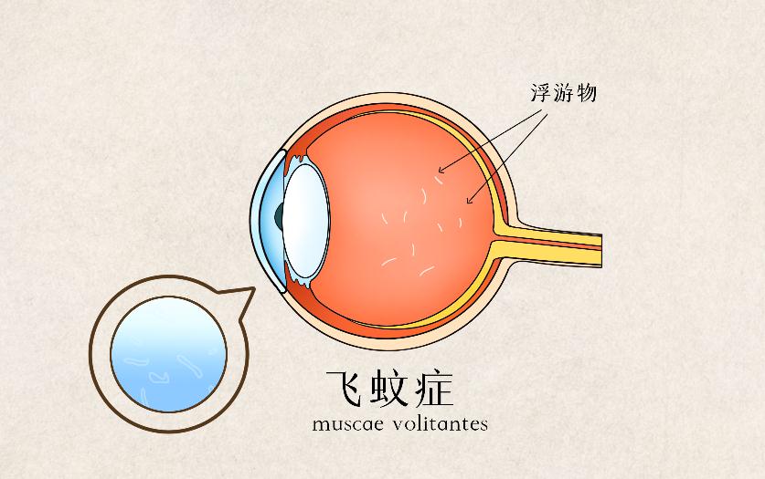 飞蚊症