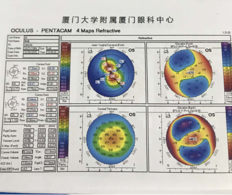 白内障手术