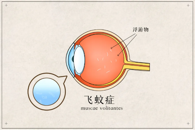 飞蚊症症状