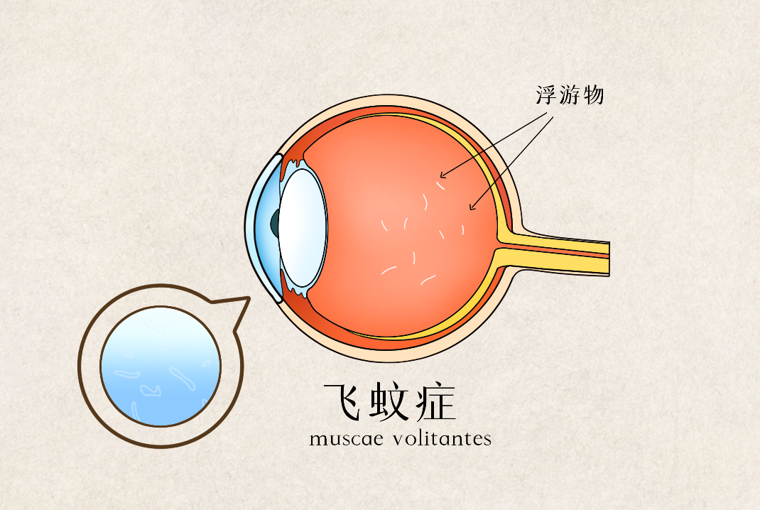 得了飞蚊症怎么办