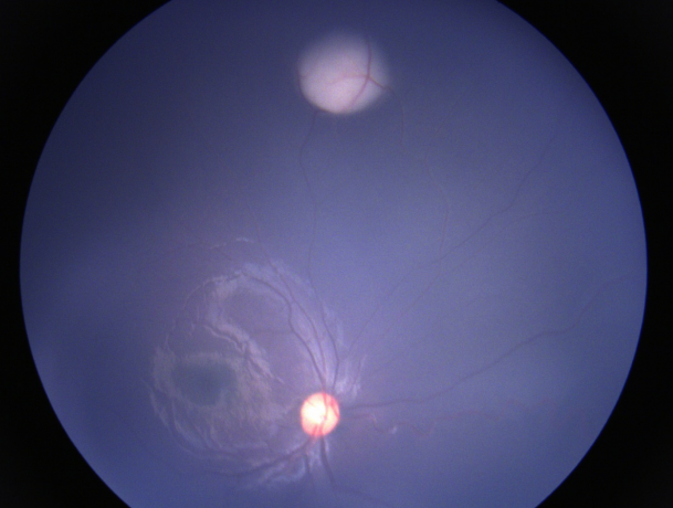 视网膜母细胞瘤治疗