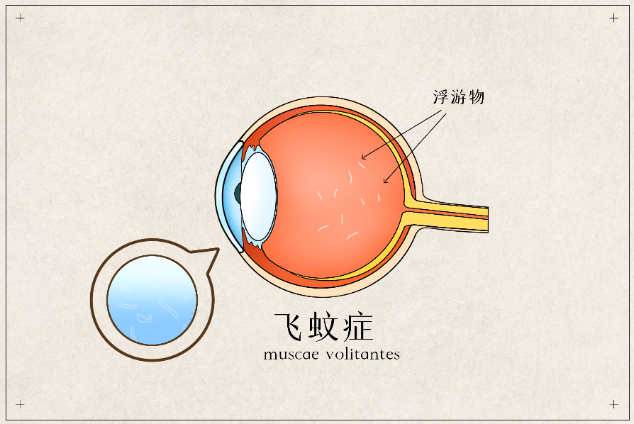 得了飞蚊症可以治吗