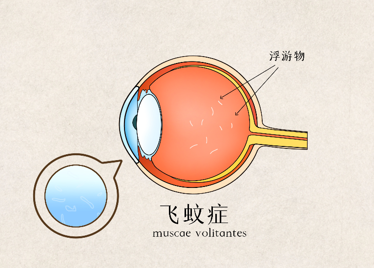 近视飞蚊症