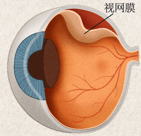 视网膜脱离