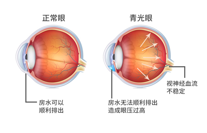 青光眼症状