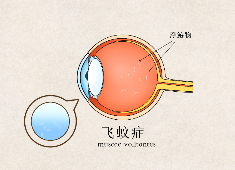 老年人眼睛飞蚊症