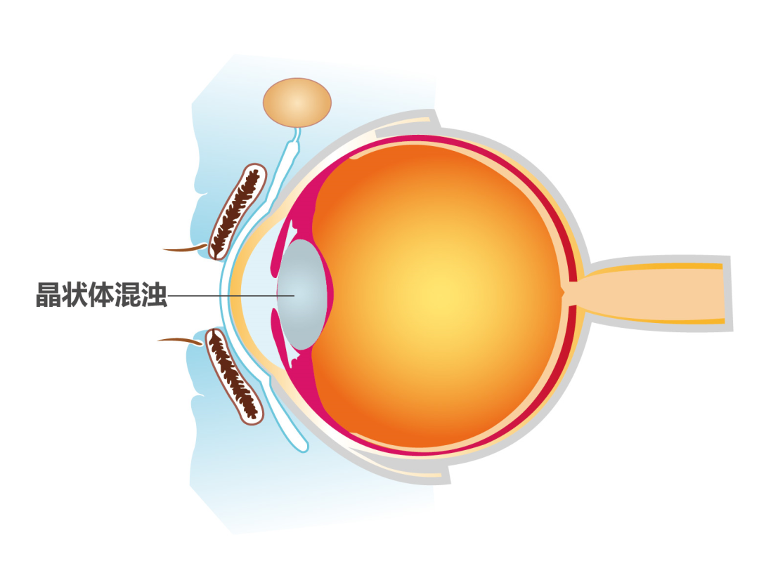 白内障症状