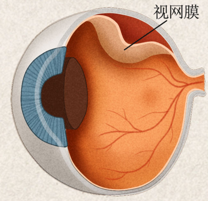 视网膜脱离