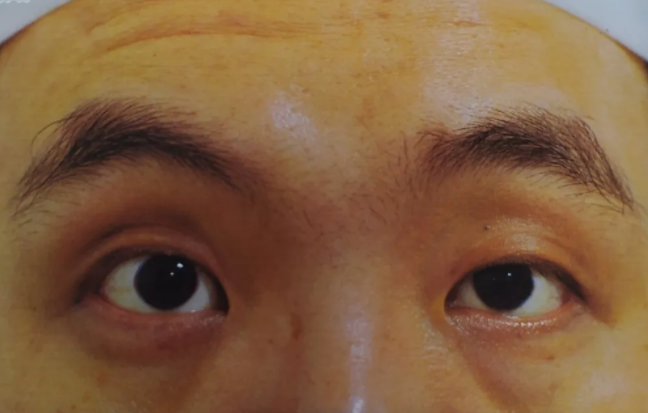 眼眶肿瘤
