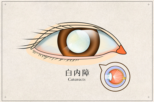 白内障手术