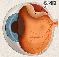 视网膜脱离