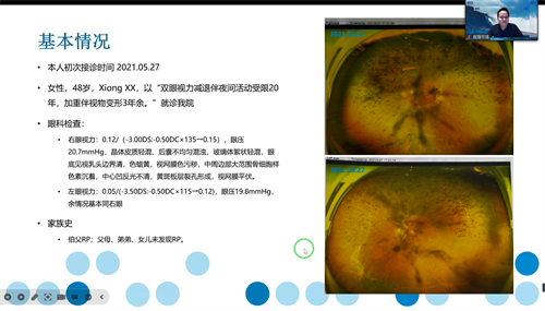 视网膜色素变性
