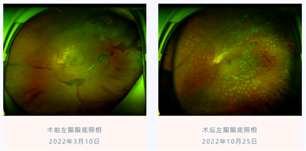 糖尿病视网膜病变